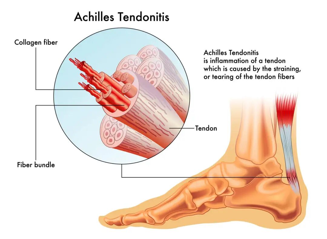 Achilles Tendinopathy - Chorley Physiotherapy