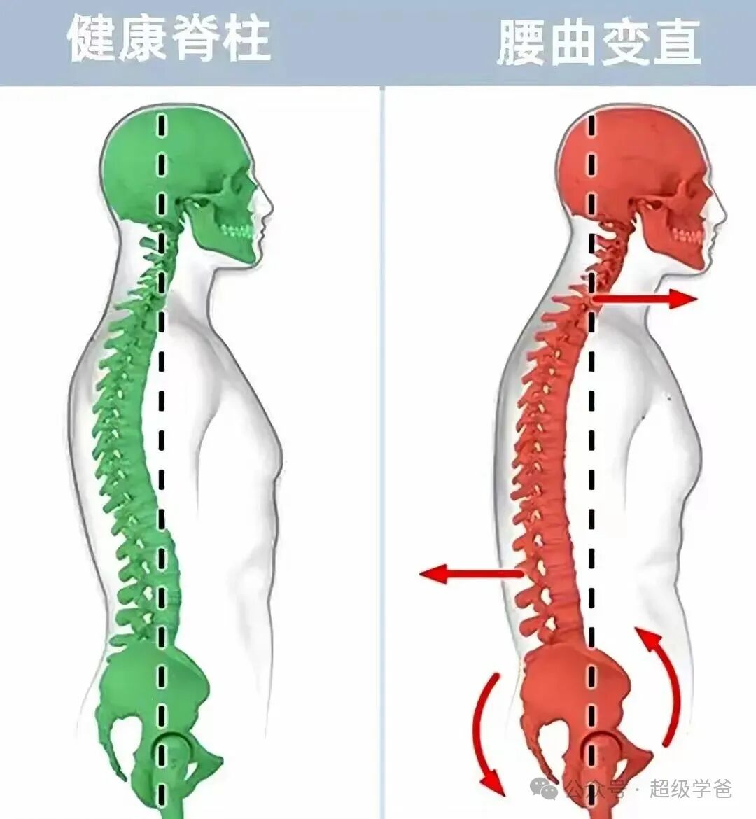 正常腰椎.jpg